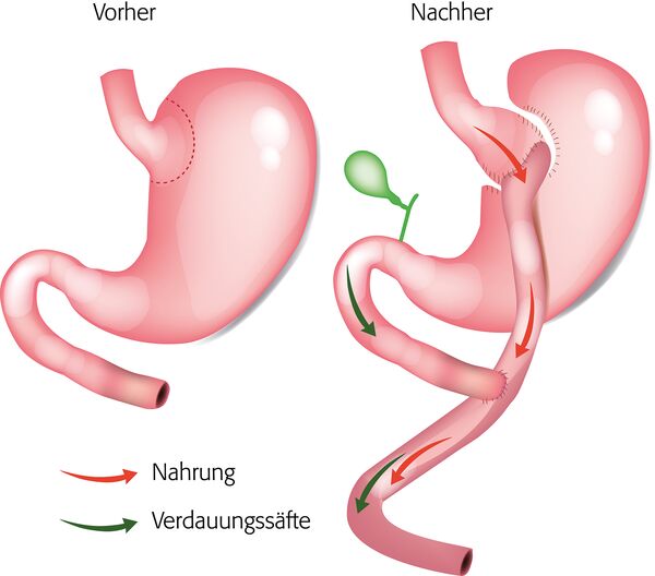 Abbildung Magenbypass