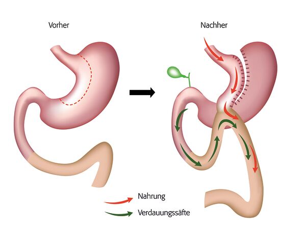 Abbildung Mini Magenbypass
